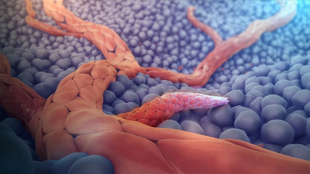 How Cancer Spreads: The Biology Behind Metastasis