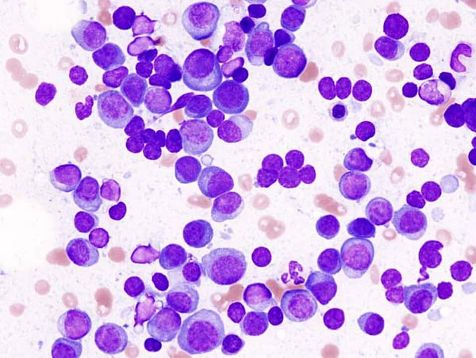 Qu’est-ce qui distingue le myélome multiple des autres cancers du sang ?